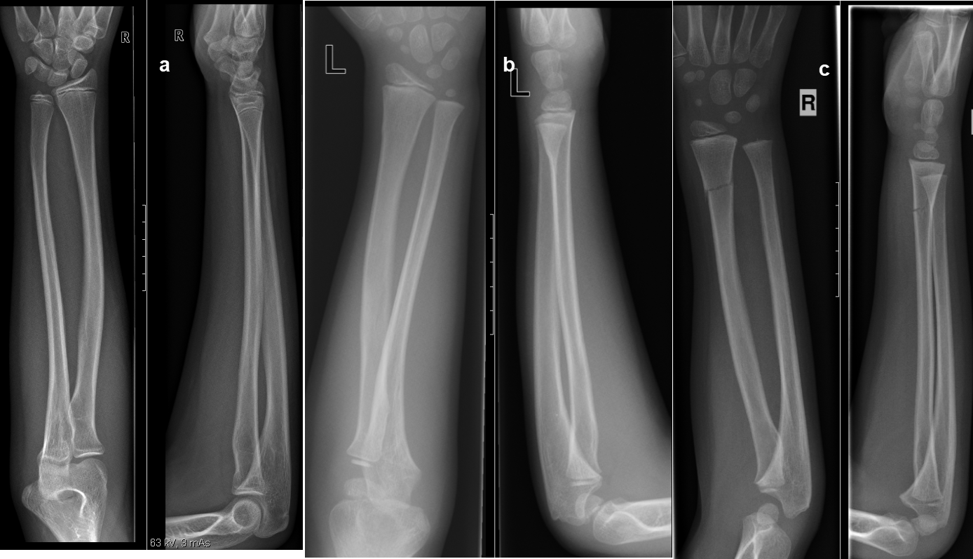 Traitement Des Fractures Un Guide Pratique P diatrie Schweiz traitement-des-fractures-un-guide-pratique-p-diatrie-schweiz